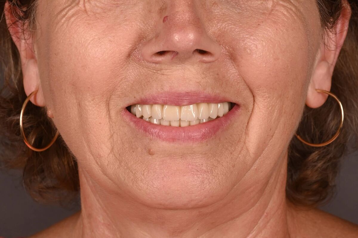 boteanu ilinca - dupa